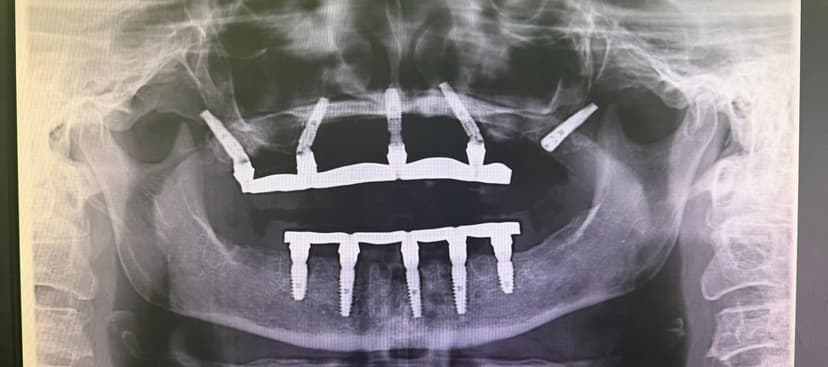 Radiografie după implantare