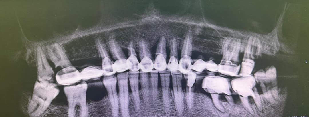 Radiografie inițială — dinți sever compromiși